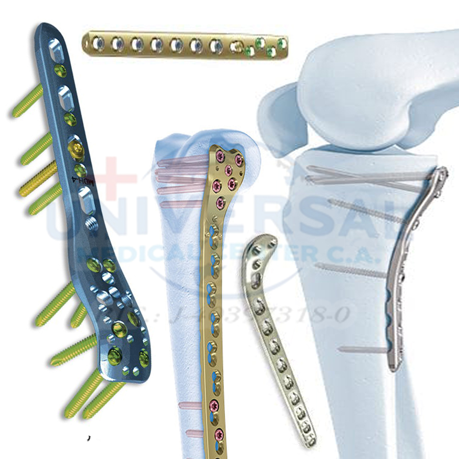 placa-tibia-perone